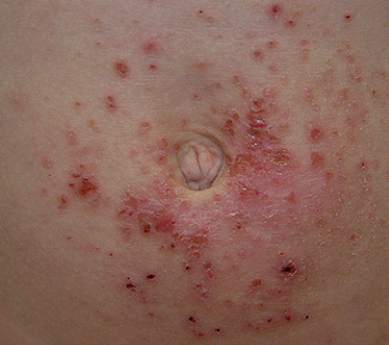 알레르기성 접촉 피부염